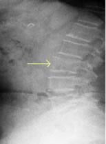 腰椎圧迫骨折のレントゲン