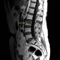 腰椎圧迫骨折のMRI
